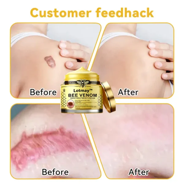 Lotmay™ Bee Venom Skin Treatment Cream